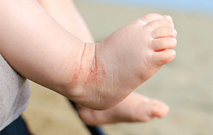Six top tips for traveling with eczema