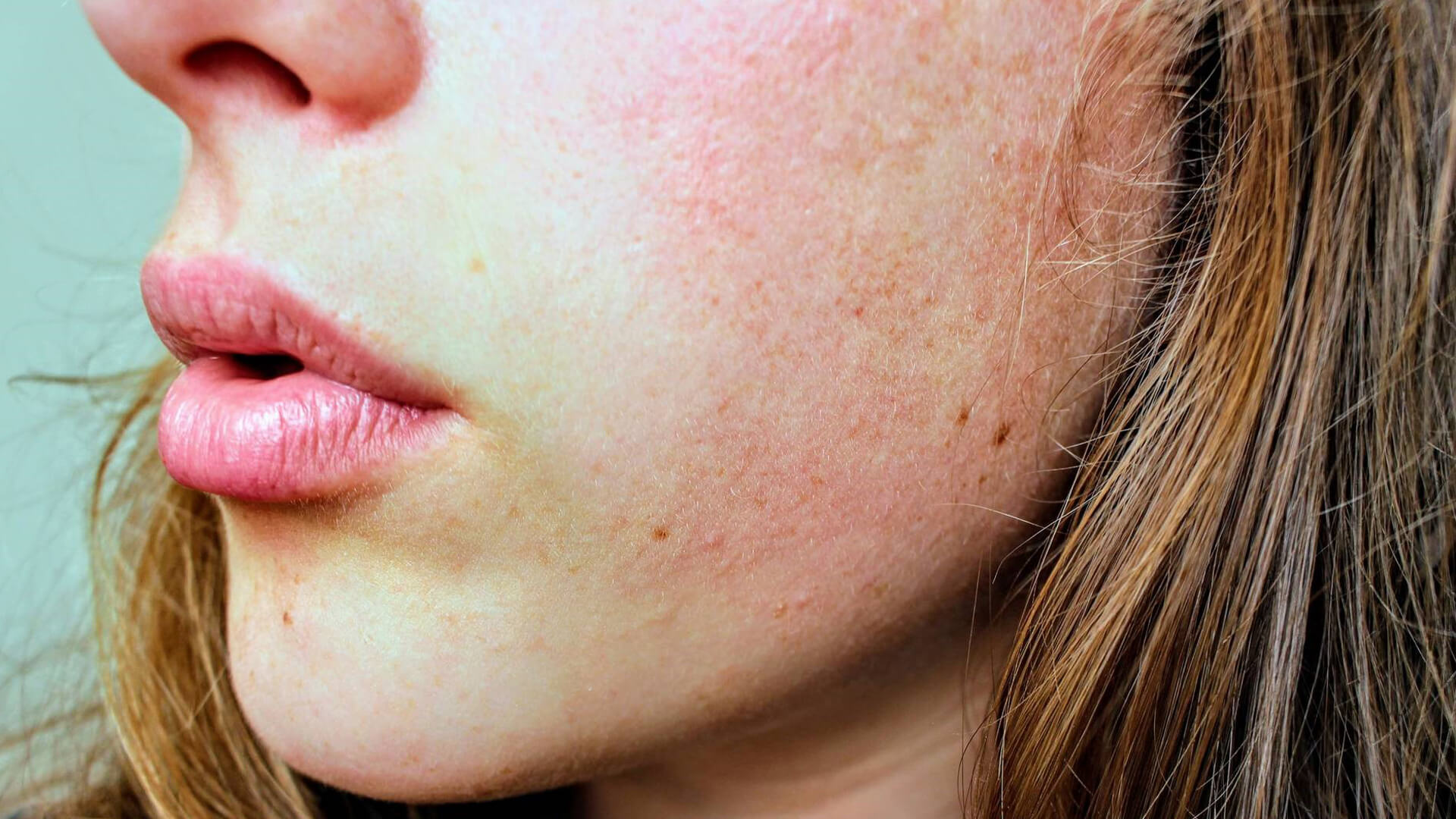 7 Common Rosacea Triggers, According To A Skin Specialist