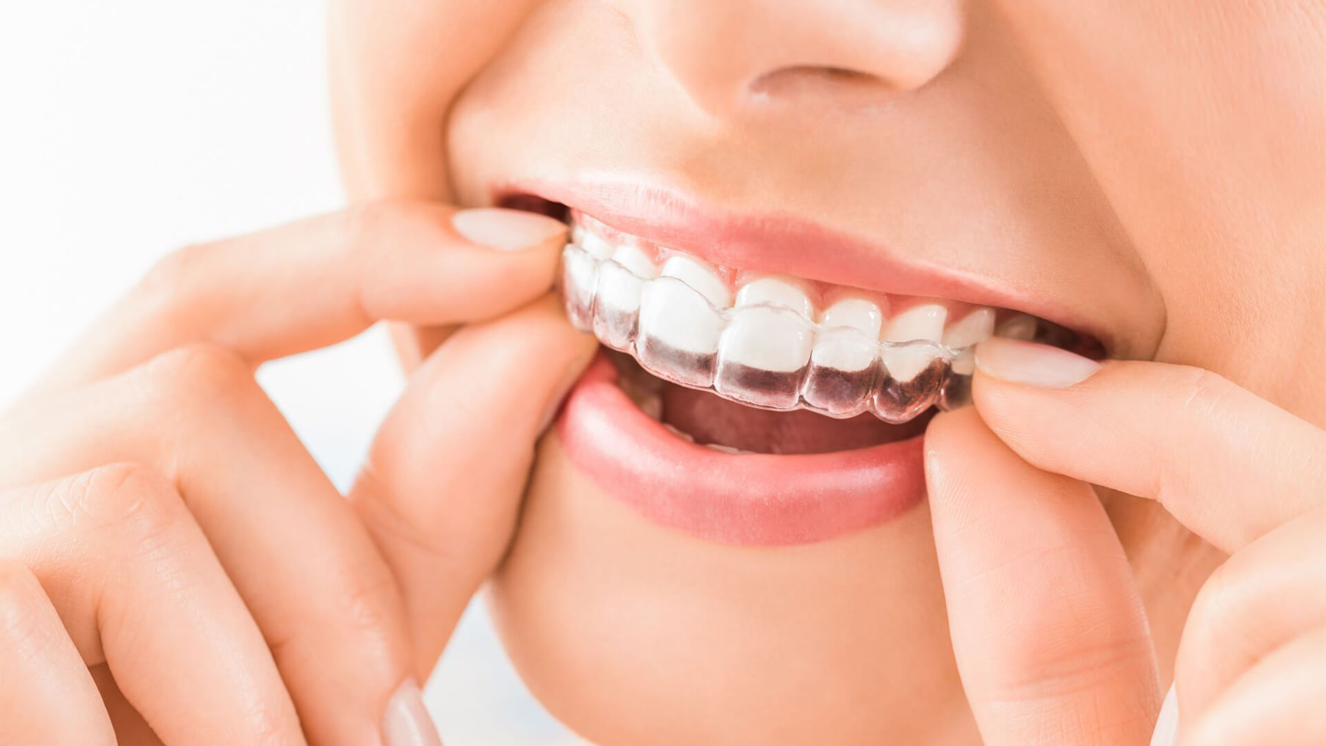 What Is Invisalign And What Can It Do For Me?