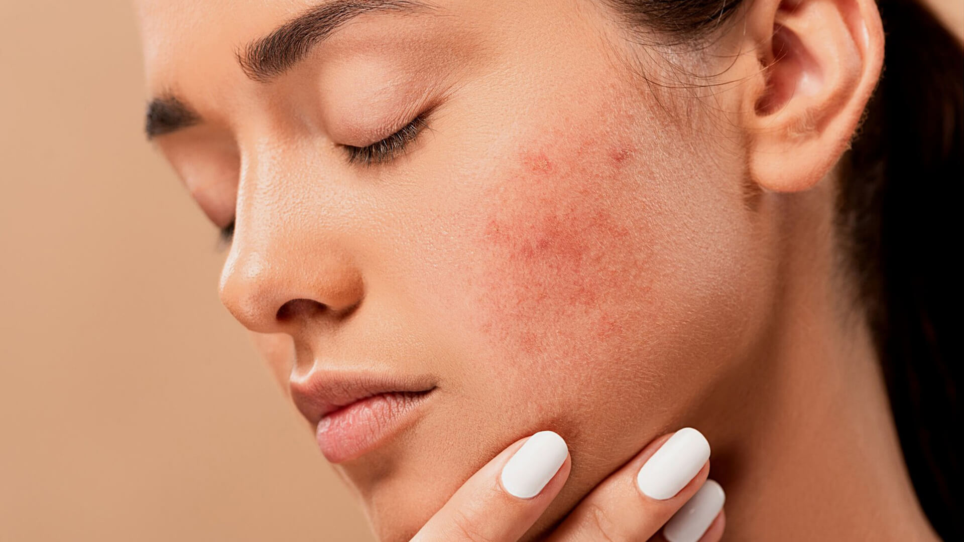 Rosacea Skincare Tips That Are Proven Effective