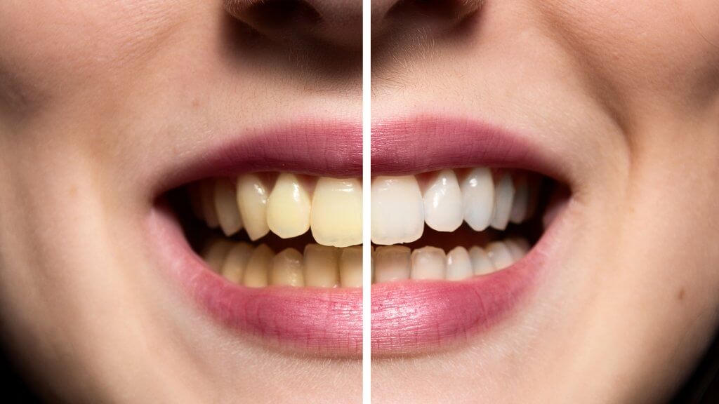 Tooth Discolouration 1024x576