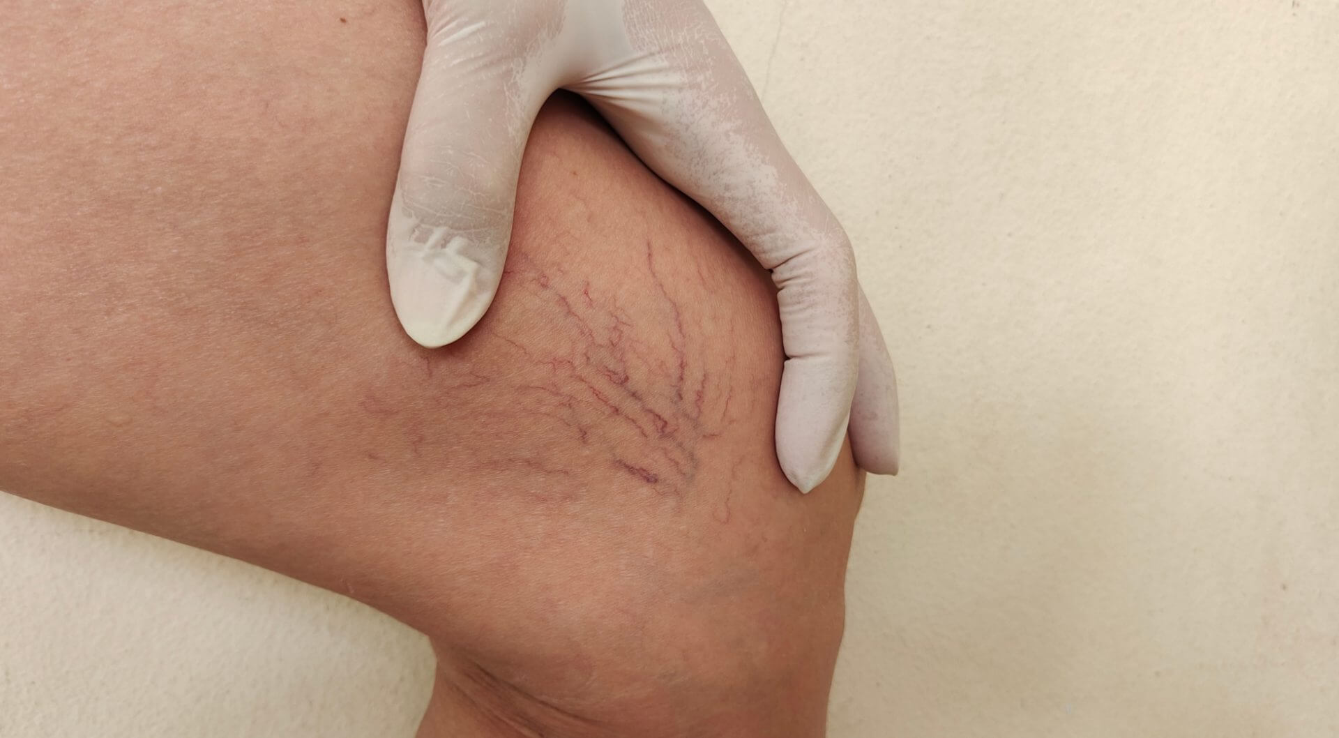 How To Know If You Have Vein Disease?