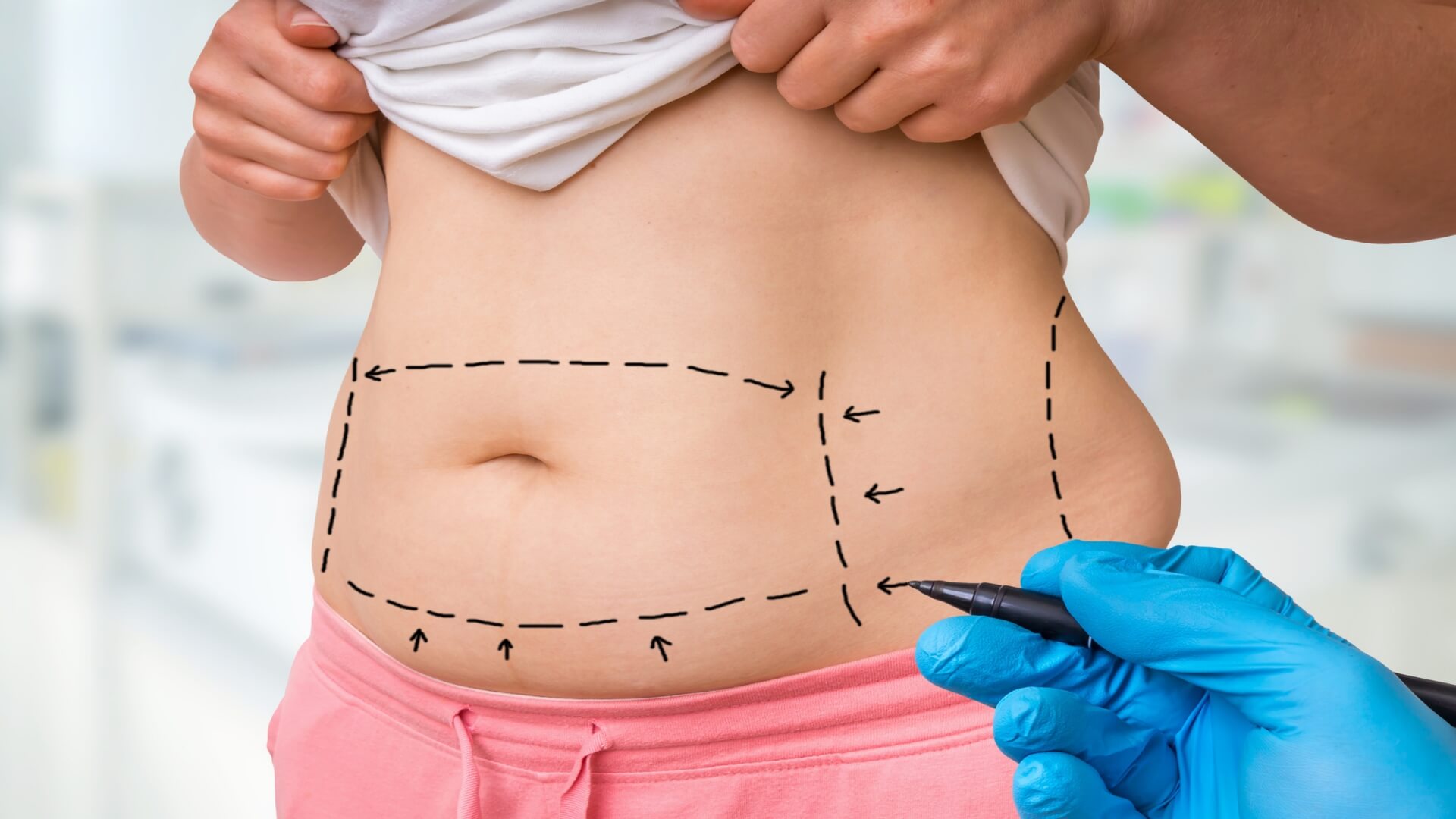 What To Consider Before Getting A Tummy Tuck 
