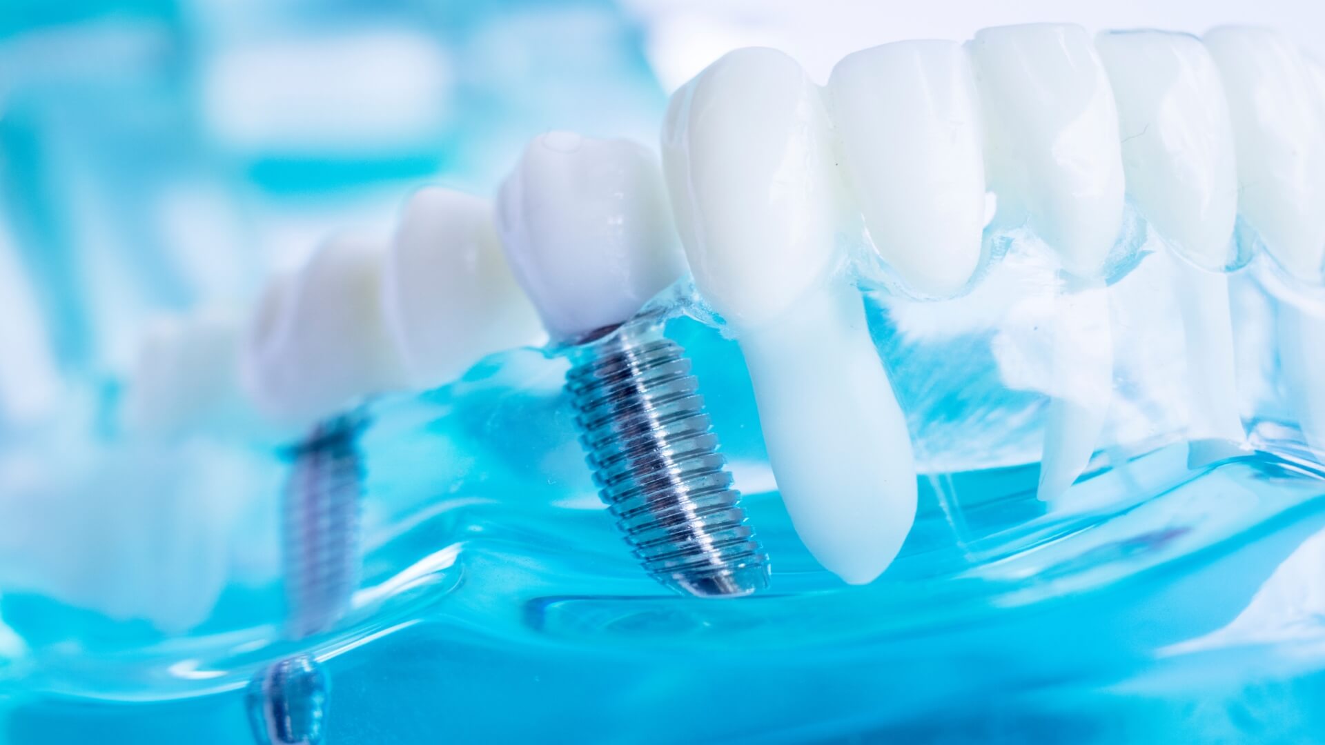 Exploring The Different Types Of Dental Implants And Their Indications